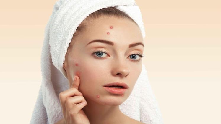 Healing Inflamed Acne: Effective Treatment Methods and Tips